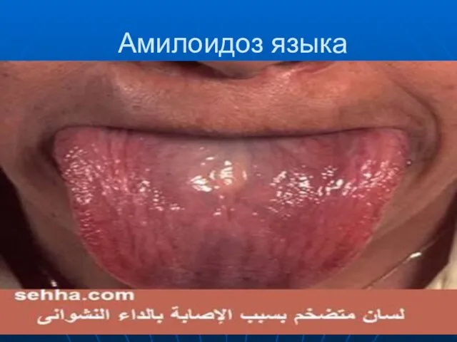 Амилоидоз языка