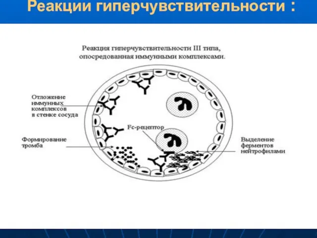 Реакции гиперчувствительности :