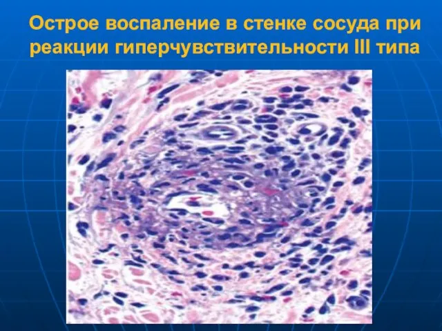 Острое воспаление в стенке сосуда при реакции гиперчувствительности III типа