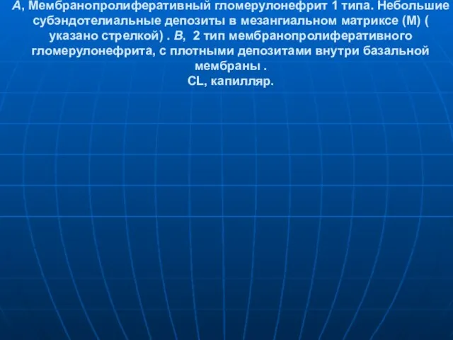 A, Мембранопролиферативный гломерулонефрит 1 типа. Небольшие субэндотелиальные депозиты в мезангиальном матриксе