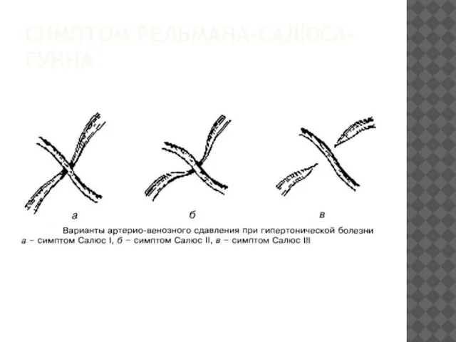 СИМПТОМ РЕЛЬМАНА-САЛЮСА-ГУННА
