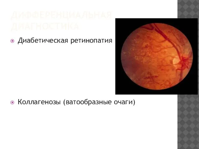 ДИФФЕРЕНЦИАЛЬНАЯ ДИАГНОСТИКА Диабетическая ретинопатия Коллагенозы (ватообразные очаги)