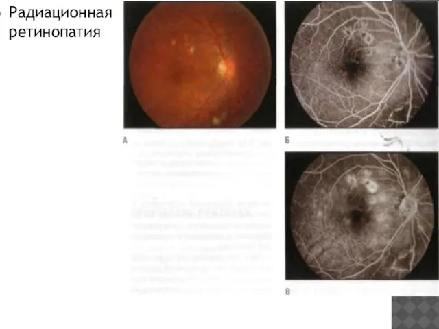 Радиационная ретинопатия