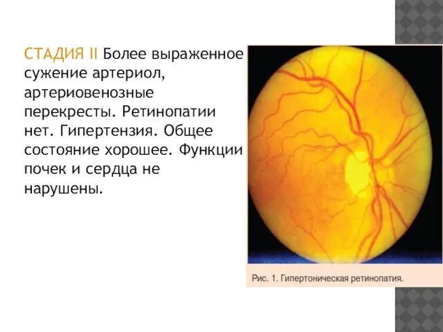 СТАДИЯ II Более выраженное сужение артериол, артериовенозные перекресты. Ретинопатии нет. Гипертензия.