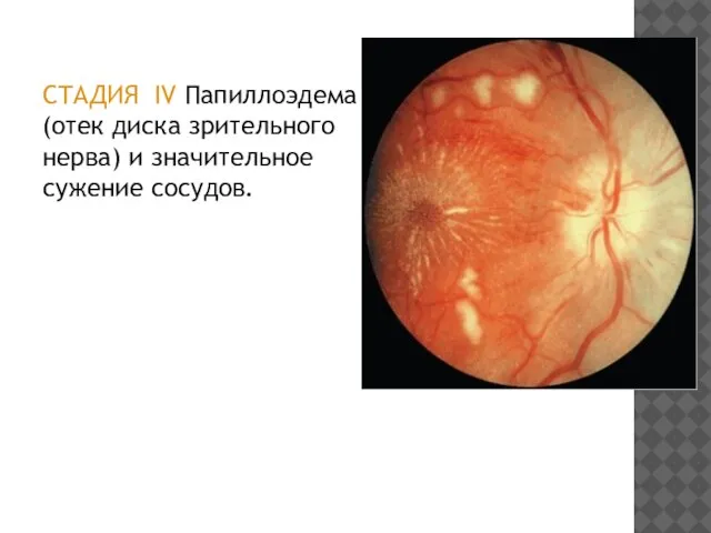 СТАДИЯ IV Папиллоэдема (отек диска зрительного нерва) и значительное сужение сосудов.