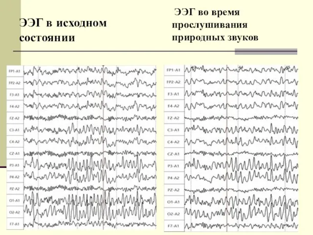 ЭЭГ в исходном состоянии ЭЭГ во время прослушивания природных звуков