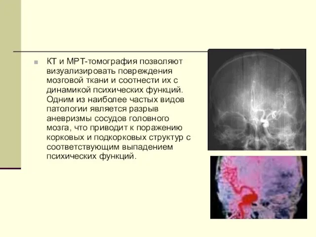 КТ и МРT-томография позволяют визуализировать повреждения мозговой ткани и соотнести их