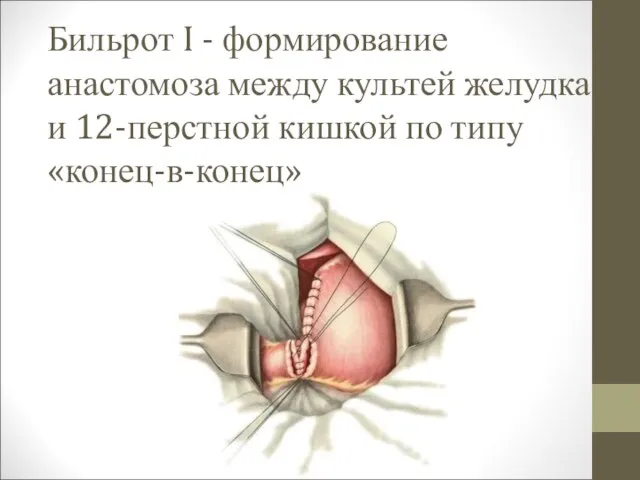 Бильрот I - формирование анастомоза между культей желудка и 12-перстной кишкой по типу «конец-в-конец»