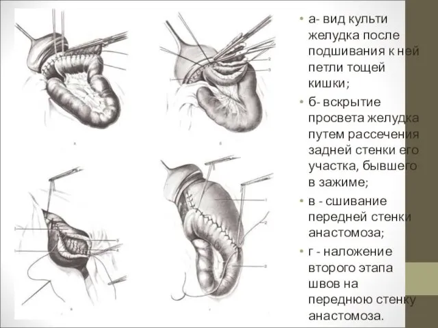 а- вид культи желудка после подшивания к ней петли тощей кишки;