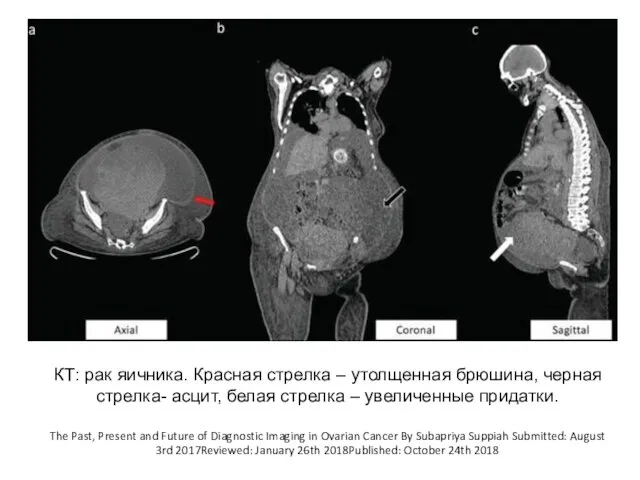 КТ: рак яичника. Красная стрелка – утолщенная брюшина, черная стрелка- асцит,