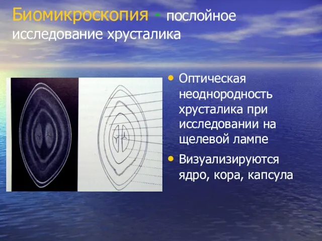 Биомикроскопия - послойное исследование хрусталика Оптическая неоднородность хрусталика при исследовании на