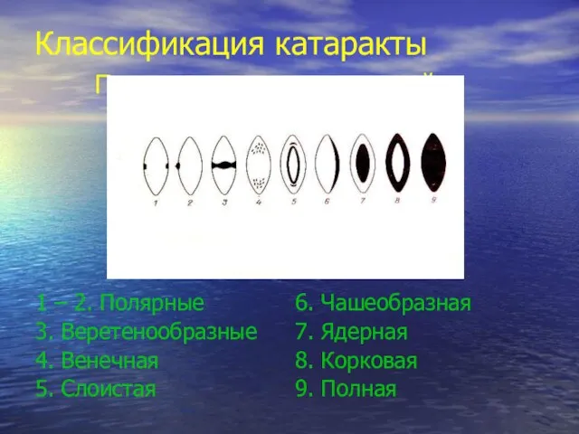 Классификация катаракты По локализации помутнений 1 – 2. Полярные 3. Веретенообразные