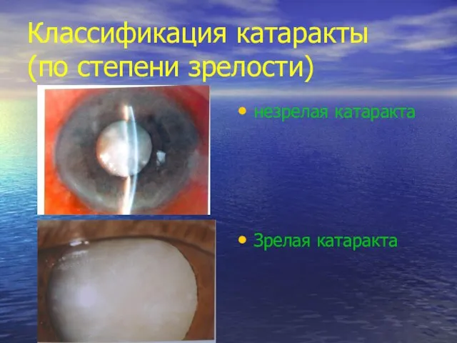 Классификация катаракты (по степени зрелости) незрелая катаракта Зрелая катаракта