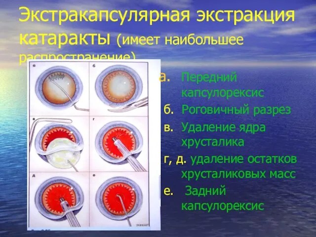 Экстракапсулярная экстракция катаракты (имеет наибольшее распространение) Передний капсулорексис б. Роговичный разрез