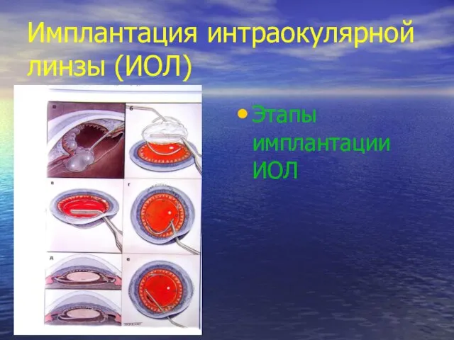 Имплантация интраокулярной линзы (ИОЛ) Этапы имплантации ИОЛ