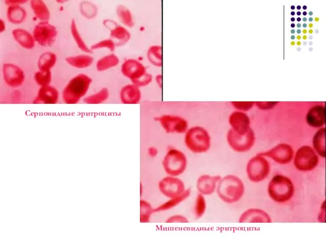 Серповидные эритроциты Мишеневидные эритроциты
