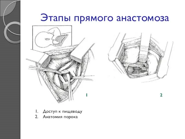 Этапы прямого анастомоза Доступ к пищеводу Анатомия порока 1 2