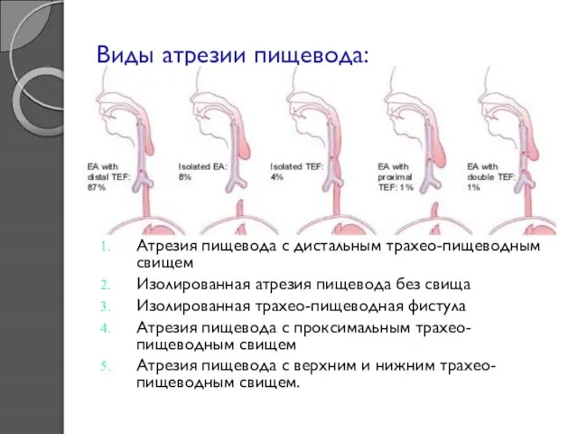 Виды атрезии пищевода: Атрезия пищевода с дистальным трахео-пищеводным свищем Изолированная атрезия