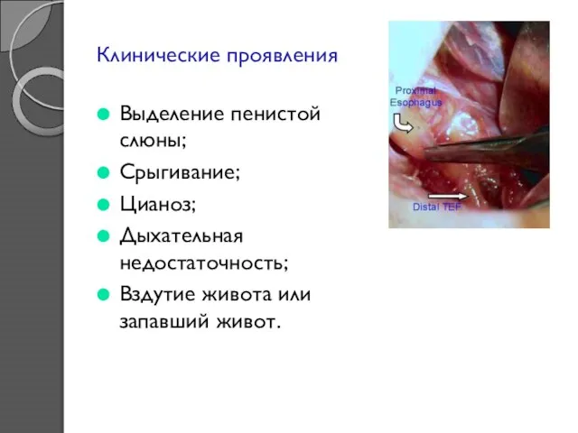 Клинические проявления Выделение пенистой слюны; Срыгивание; Цианоз; Дыхательная недостаточность; Вздутие живота или запавший живот.