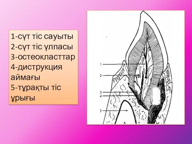 1-сүт тіс сауыты 2-сүт тіс үлпасы 3-остеокласттар 4-диструкция аймағы 5-тұрақты тіс ұрығы