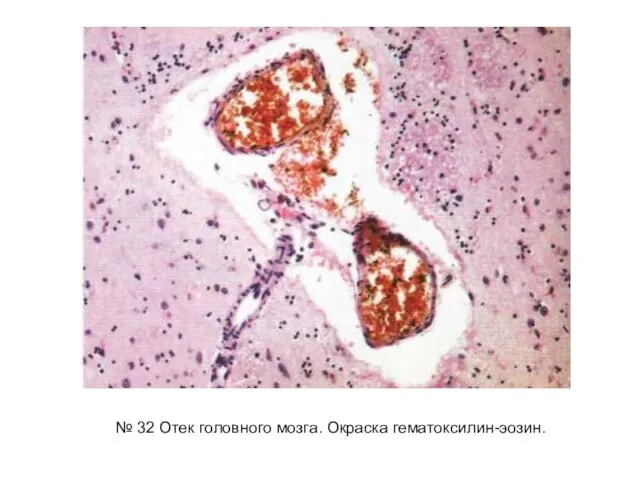 № 32 Отек головного мозга. Окраска гематоксилин-эозин.