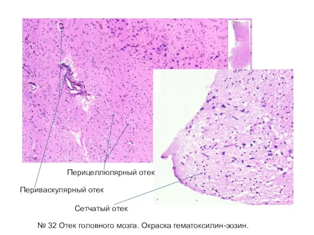 № 32 Отек головного мозга. Окраска гематоксилин-эозин. Сетчатый отек Периваскулярный отек Перицеллюлярный отек