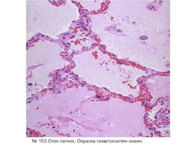 № 153 Отек легких. Окраска гематоксилин-эозин.