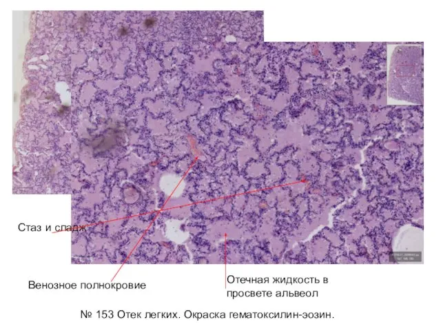 № 153 Отек легких. Окраска гематоксилин-эозин. Стаз и сладж Венозное полнокровие Отечная жидкость в просвете альвеол