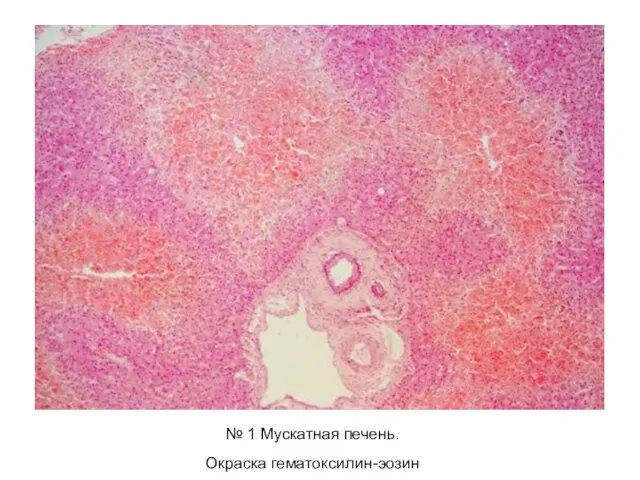 № 1 Мускатная печень. Окраска гематоксилин-эозин