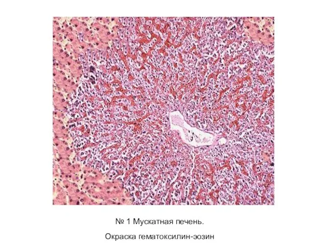№ 1 Мускатная печень. Окраска гематоксилин-эозин