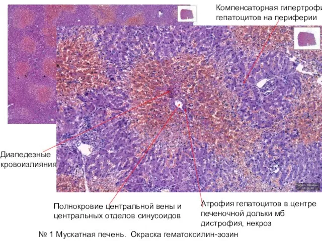 № 1 Мускатная печень. Окраска гематоксилин-эозин Диапедезные кровоизлияния Полнокровие центральной вены