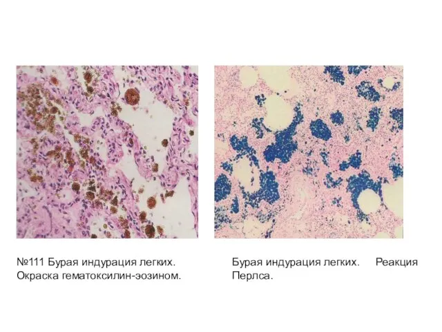 №111 Бурая индурация легких. Окраска гематоксилин-эозином. Бурая индурация легких. Реакция Перлса.
