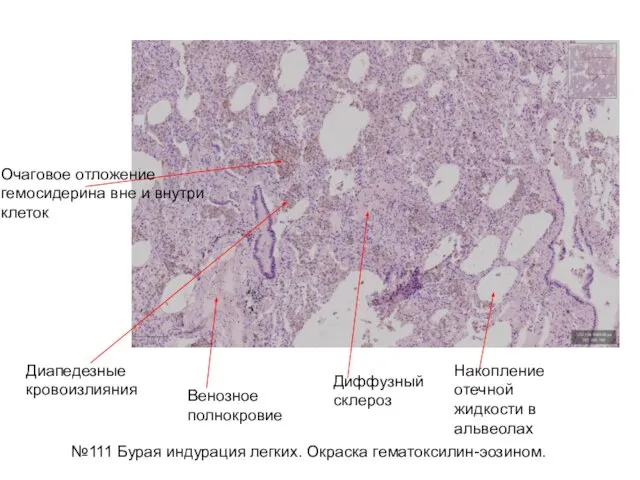 №111 Бурая индурация легких. Окраска гематоксилин-эозином. Очаговое отложение гемосидерина вне и