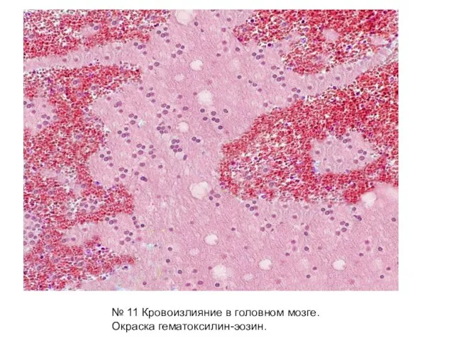 № 11 Кровоизлияние в головном мозге. Окраска гематоксилин-эозин.