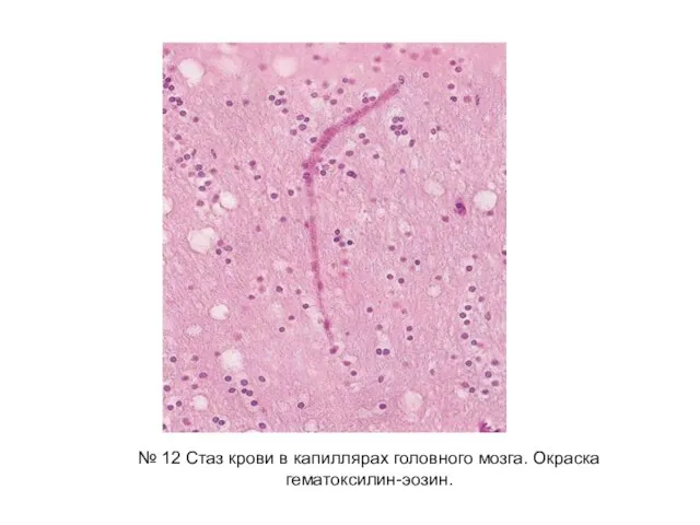 № 12 Стаз крови в капиллярах головного мозга. Окраска гематоксилин-эозин.
