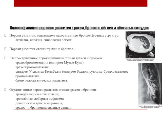 Классификация пороков развития трахеи, бронхов, лёгких и лёгочных сосудов Пороки развития,