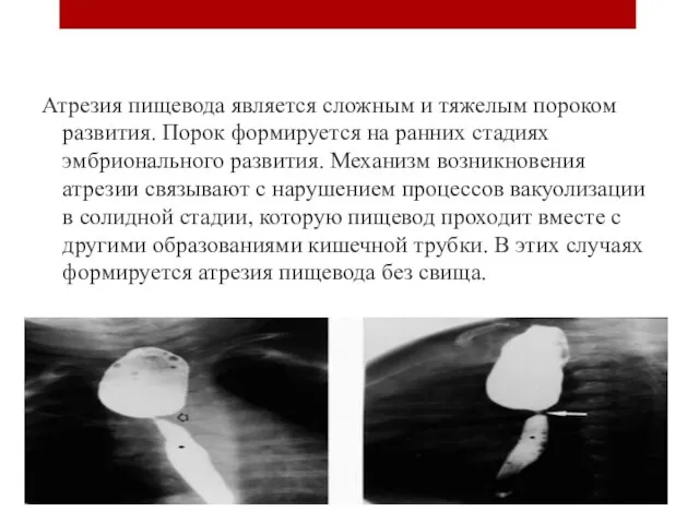 Артезия пищевода Атрезия пищевода является сложным и тяжелым пороком развития. Порок