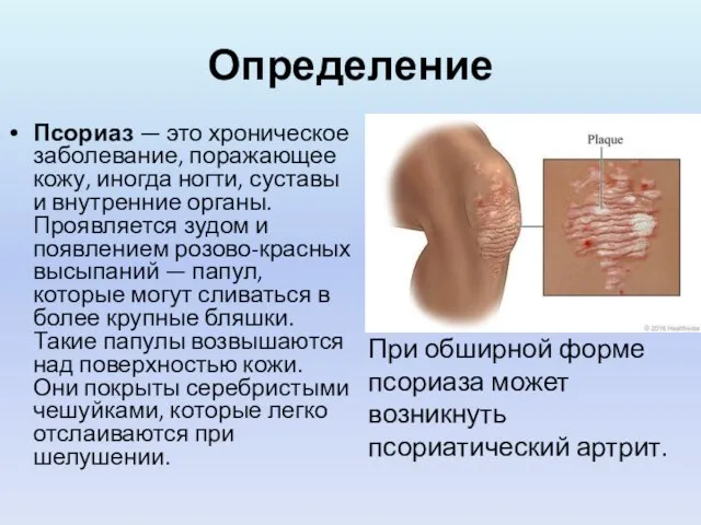 Определение Псориаз — это хроническое заболевание, поражающее кожу, иногда ногти, суставы