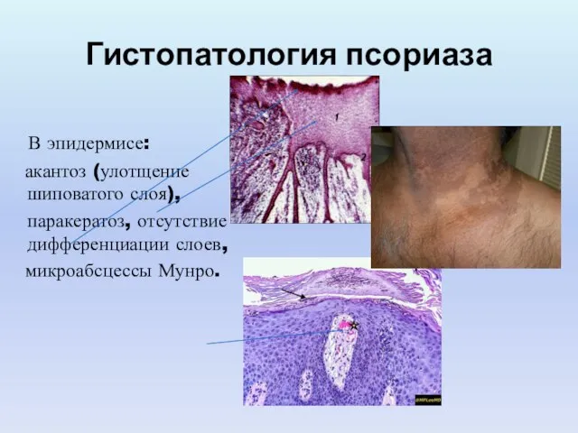 Гистопатология псориаза В эпидермисе: акантоз (улотщение шиповатого слоя), паракератоз, отсутствие дифференциации слоев, микроабсцессы Мунро.