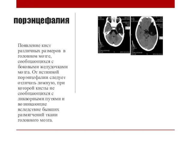 порэнцефалия Появление кист различных размеров в головном мозге, сообщающихся с боковыми