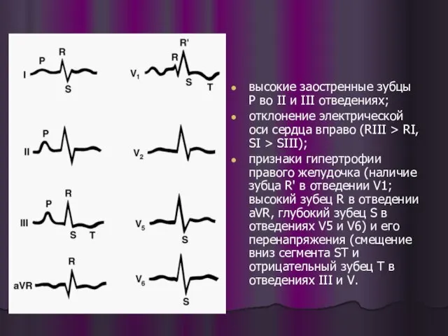 высокие заостренные зубцы Р во II и III отведениях; отклонение электрической