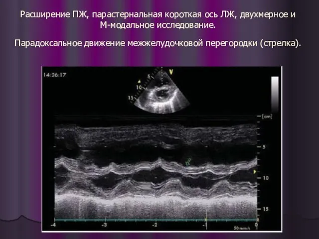 Расширение ПЖ, парастернальная короткая ось ЛЖ, двухмерное и М-модальное исследование. Парадоксальное движение межжелудочковой перегородки (стрелка).