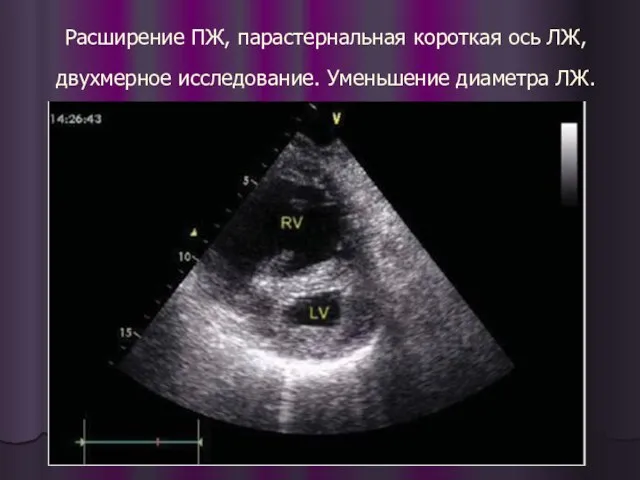 Расширение ПЖ, парастернальная короткая ось ЛЖ, двухмерное исследование. Уменьшение диаметра ЛЖ.