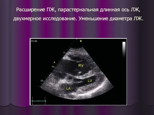 Расширение ПЖ, парастернальная длинная ось ЛЖ, двухмерное исследование. Уменьшение диаметра ЛЖ.