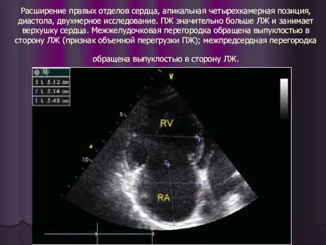 Расширение правых отделов сердца, апикальная четырехкамерная позиция, диастола, двухмерное исследование. ПЖ