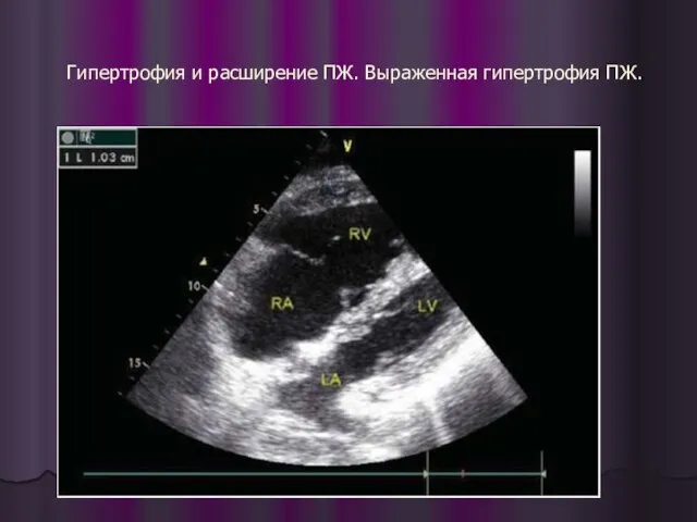 Гипертрофия и расширение ПЖ. Выраженная гипертрофия ПЖ.