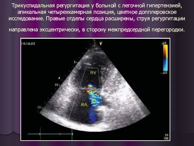 Трикуспидальная регургитация у больной с легочной гипертензией, апикальная четырехкамерная позиция, цветное