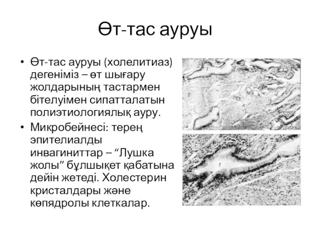 Өт-тас ауруы Өт-тас ауруы (холелитиаз) дегеніміз – өт шығару жолдарының тастармен