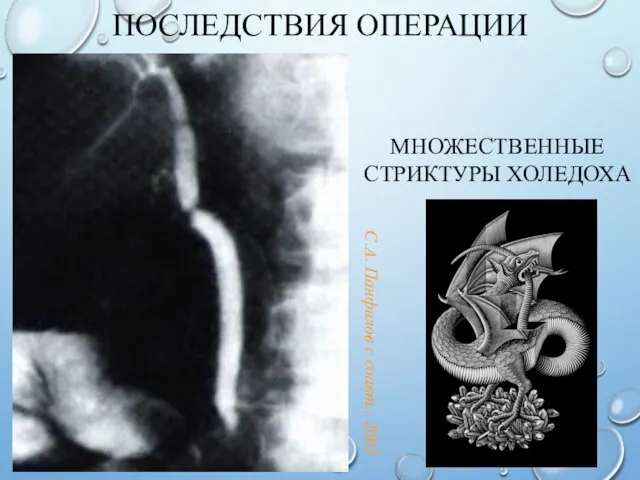 ПОСЛЕДСТВИЯ ОПЕРАЦИИ МНОЖЕСТВЕННЫЕ СТРИКТУРЫ ХОЛЕДОХА С.А. Панфилов с соавт., 2003