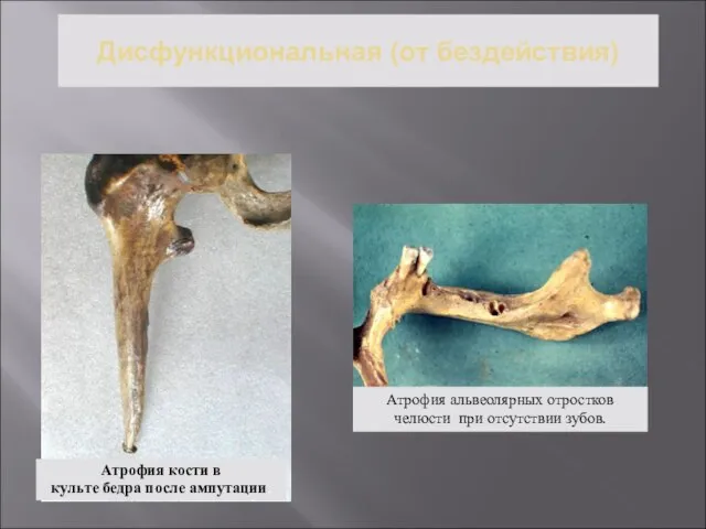 Дисфункциональная (от бездействия) Атрофия кости в культе бедра после ампутации. Атрофия